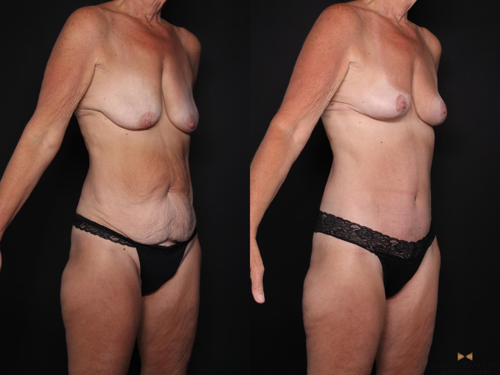 Before & After Tummy Tuck Case 725 Right Oblique View in Fort Worth & Arlington, Texas