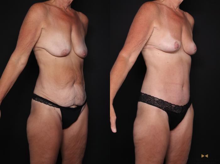 Before & After Mommy Makeover Case 725 Right Oblique View in Fort Worth & Arlington, Texas