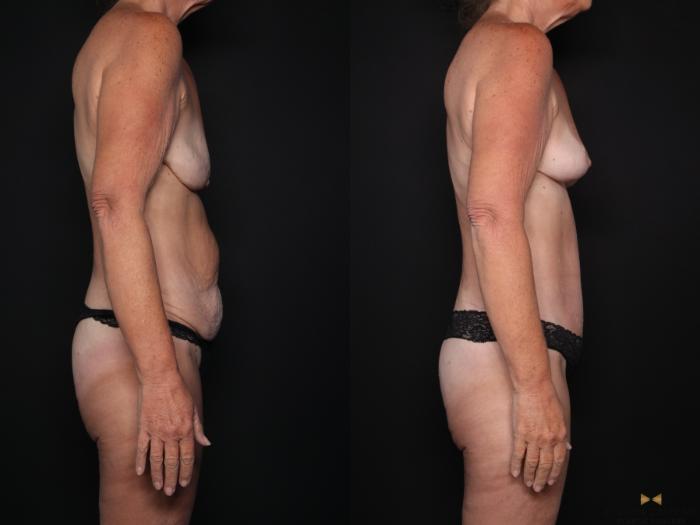 Before & After Mommy Makeover Case 725 Right Side View in Fort Worth & Arlington, Texas
