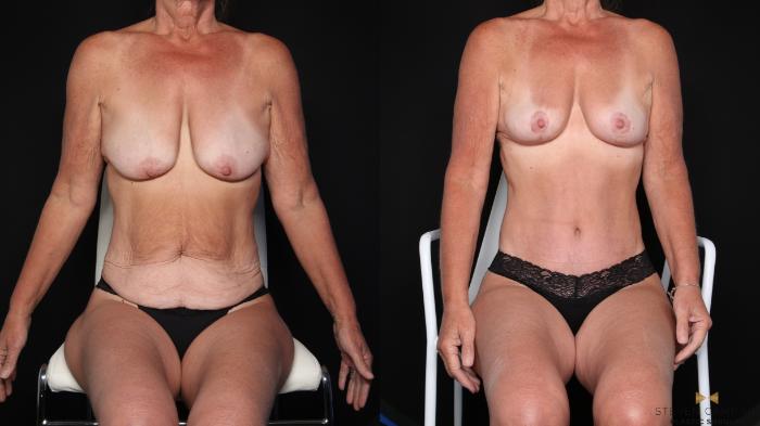 Before & After Mommy Makeover Case 725 Seated View in Fort Worth & Arlington, Texas