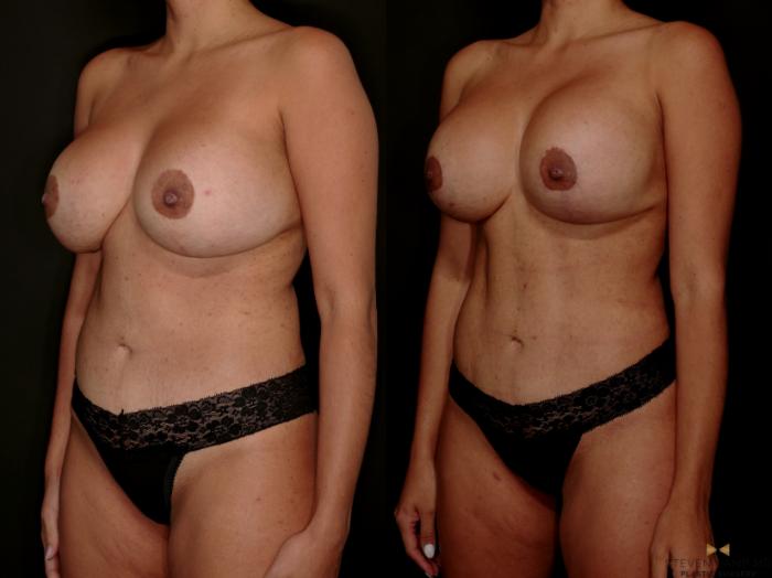 Before & After Mommy Makeover Case 729 Left Oblique View in Fort Worth & Arlington, Texas