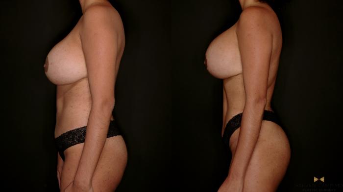 Before & After Mommy Makeover Case 729 Left Side View in Fort Worth & Arlington, Texas