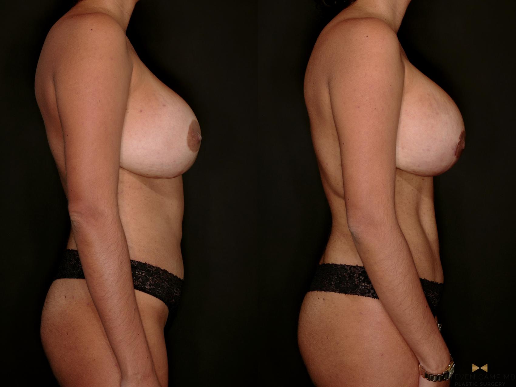 Before & After Internal Bra (Galaflex) Case 729 Right Side View in Fort Worth & Arlington, Texas