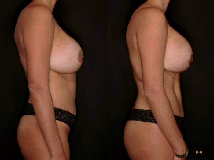 Before & After Mommy Makeover Case 729 Right Side View in Fort Worth & Arlington, Texas