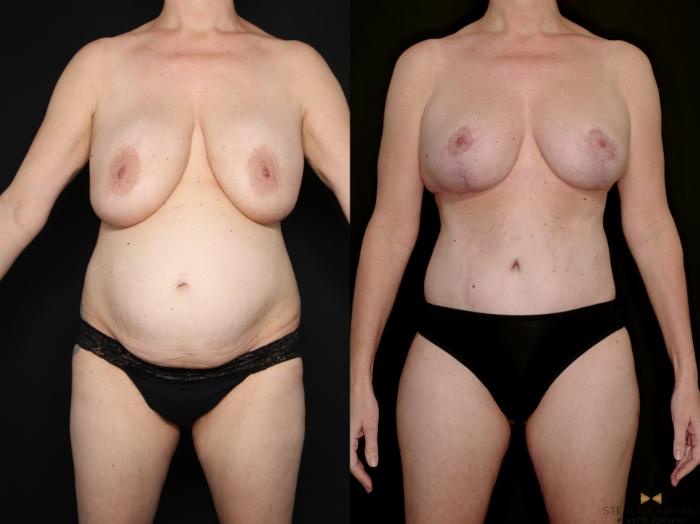 Before & After Internal Bra (Galaflex) Case 730 Front View in Fort Worth & Arlington, Texas