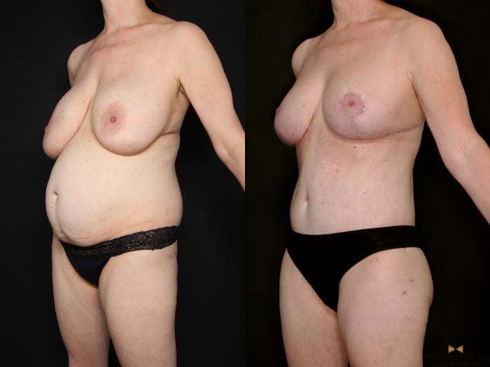 Before & After Internal Bra (Galaflex) Case 730 Left Oblique View in Fort Worth & Arlington, Texas