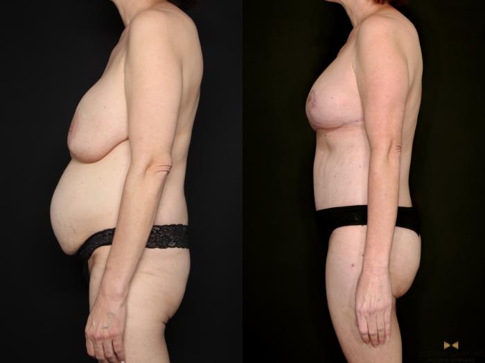 Before & After Internal Bra (Galaflex) Case 730 Left Side View in Fort Worth & Arlington, Texas