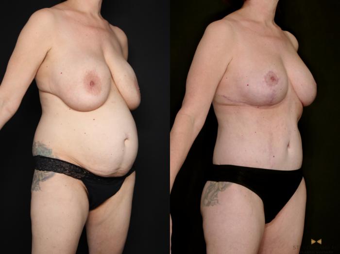 Before & After Internal Bra (Galaflex) Case 730 Right Oblique View in Fort Worth & Arlington, Texas
