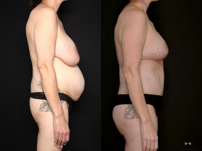 Before & After Internal Bra (Galaflex) Case 730 Right Side View in Fort Worth & Arlington, Texas