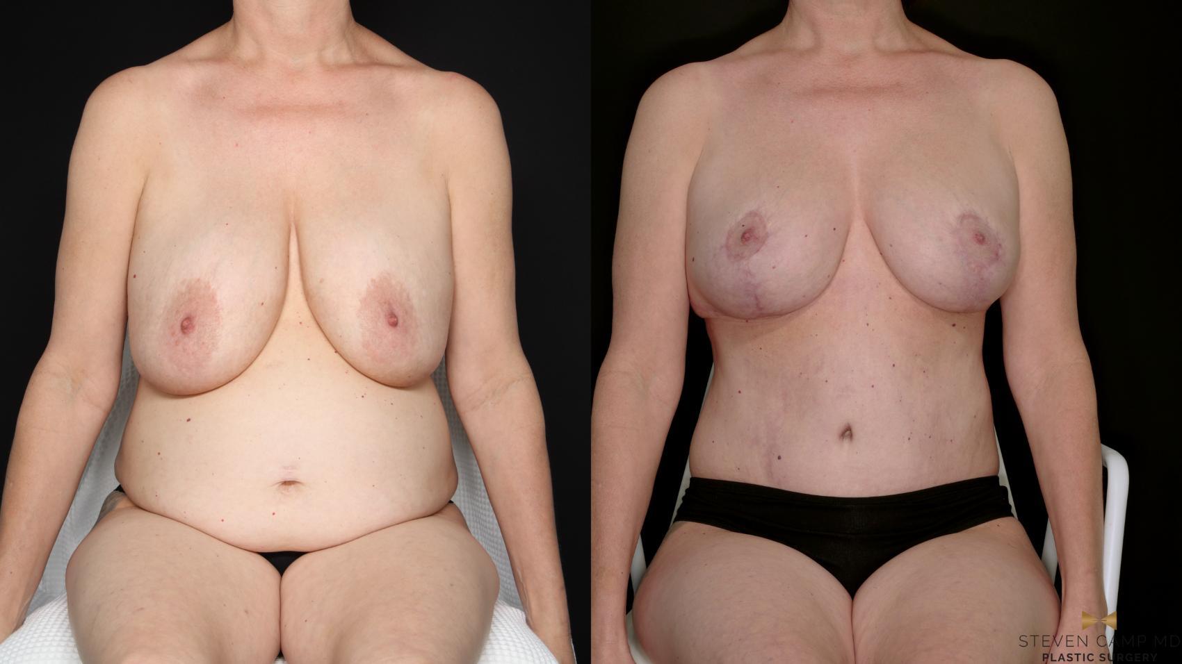 Before & After Mommy Makeover Case 730 Seated View in Fort Worth & Arlington, Texas