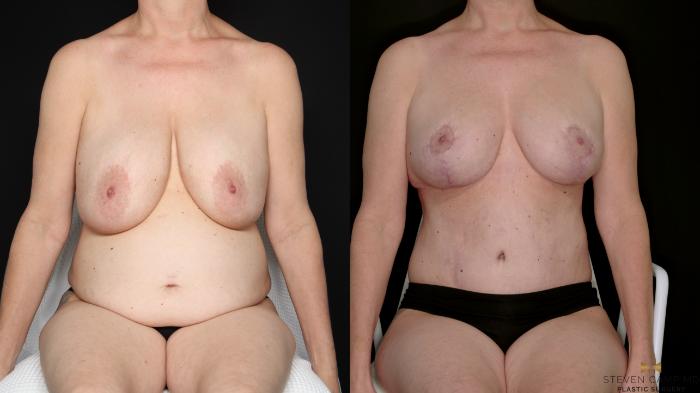 Before & After Internal Bra (Galaflex) Case 730 Seated View in Fort Worth & Arlington, Texas