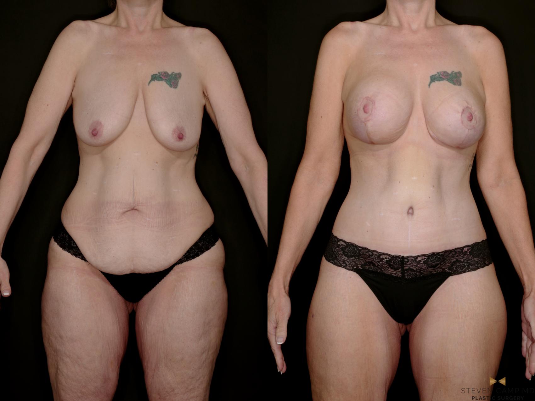 Before & After Mommy Makeover Case 739 Front View in Fort Worth & Arlington, Texas
