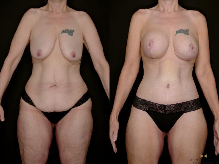 Before & After Mommy Makeover Case 739 Front View in Fort Worth & Arlington, Texas