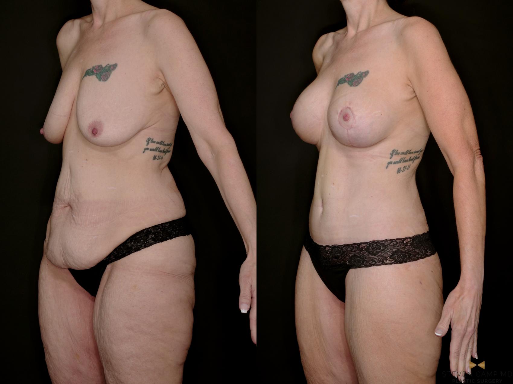 Before & After Mommy Makeover Case 739 Left Oblique View in Fort Worth & Arlington, Texas