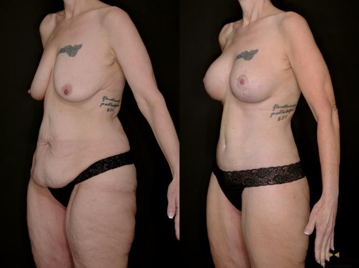Before & After Mommy Makeover Case 739 Left Oblique View in Fort Worth & Arlington, Texas