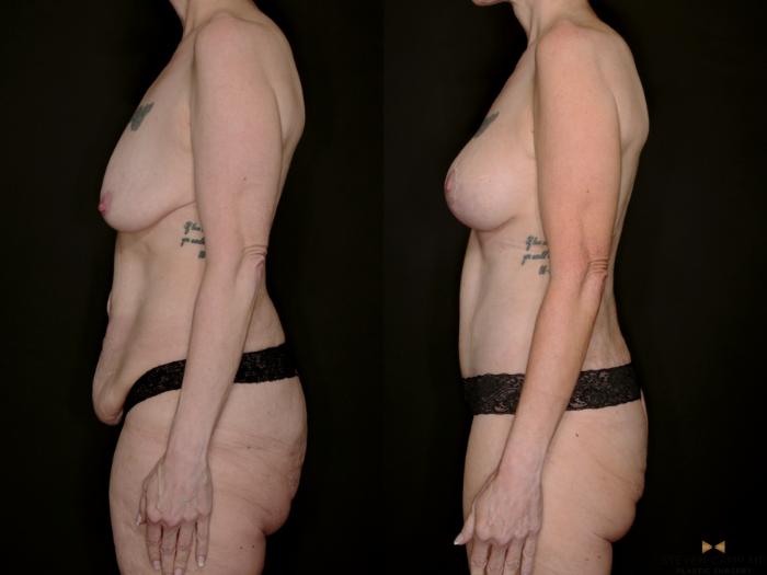 Before & After Mommy Makeover Case 739 Left Side View in Fort Worth & Arlington, Texas