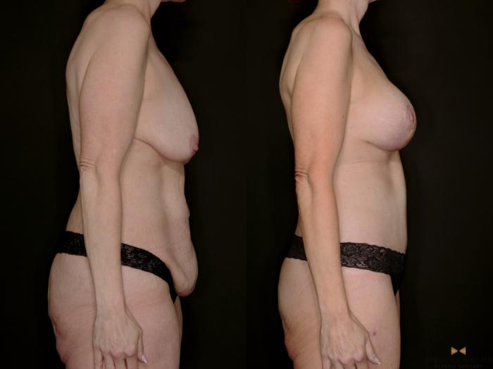 Before & After Mommy Makeover Case 739 Right Side View in Fort Worth & Arlington, Texas