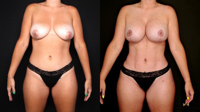 Before & After Mommy Makeover Case 742 Front View in Fort Worth & Arlington, Texas