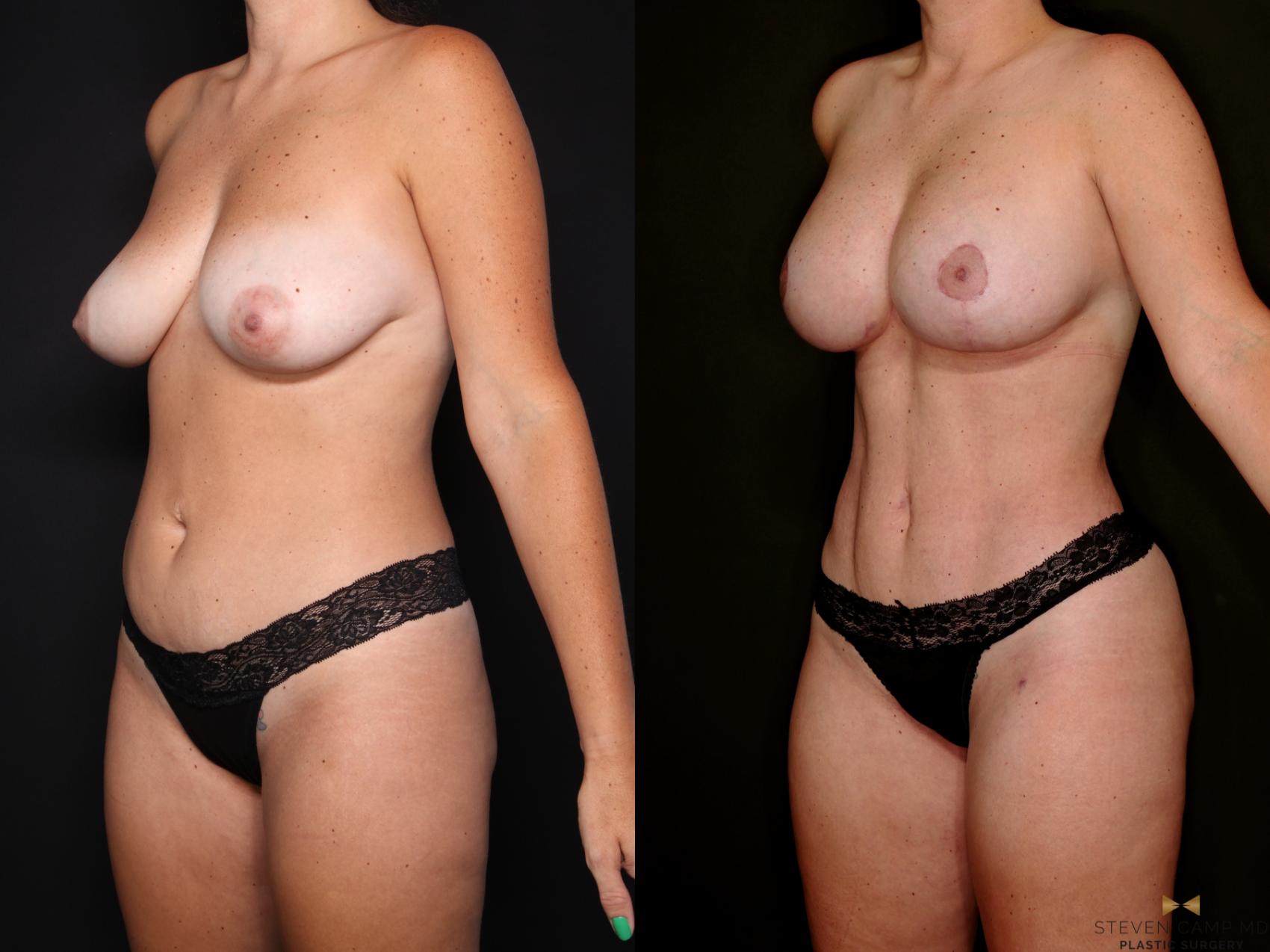 Before & After Mommy Makeover Case 742 Left Oblique View in Fort Worth & Arlington, Texas