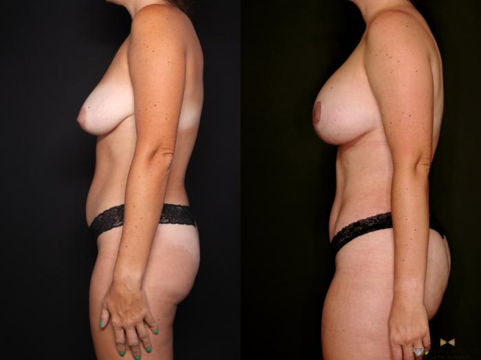 Before & After Mommy Makeover Case 742 Left Side View in Fort Worth & Arlington, Texas