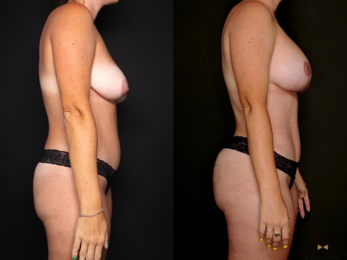 Before & After Mommy Makeover Case 742 Right Side View in Fort Worth & Arlington, Texas