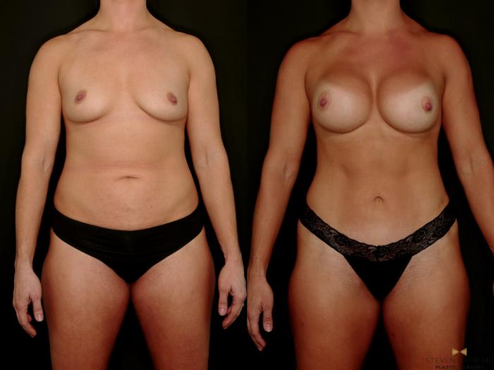 Before & After Tummy Tuck Case 746 Front View in Fort Worth & Arlington, Texas