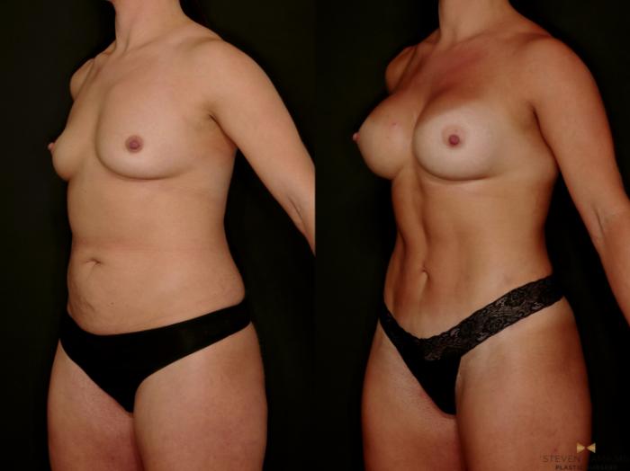 Before & After Tummy Tuck Case 746 Left Oblique View in Fort Worth & Arlington, Texas