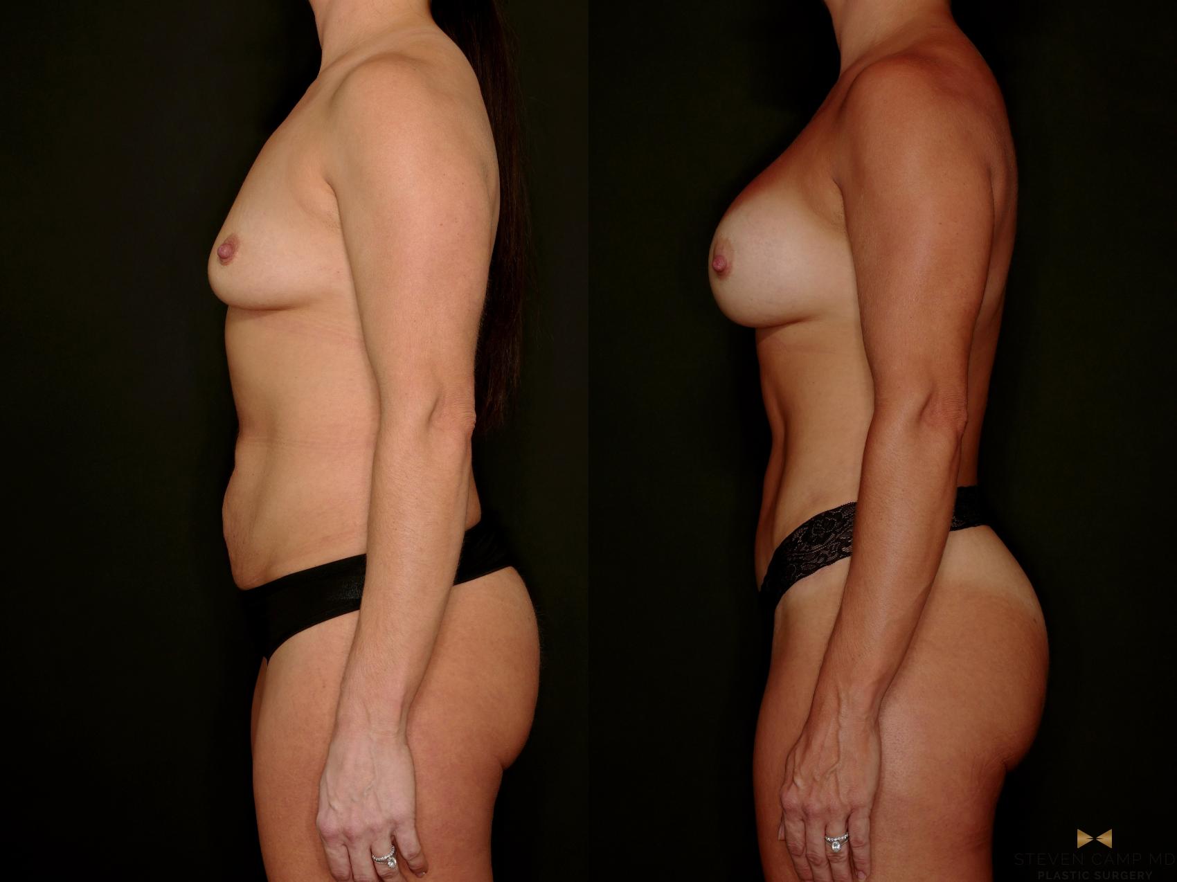 Before & After Tummy Tuck Case 746 Left Side View in Fort Worth & Arlington, Texas