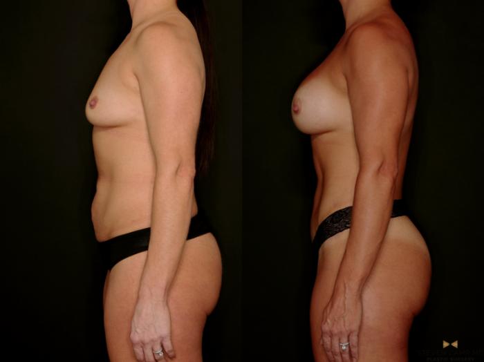 Before & After Tummy Tuck Case 746 Left Side View in Fort Worth & Arlington, Texas
