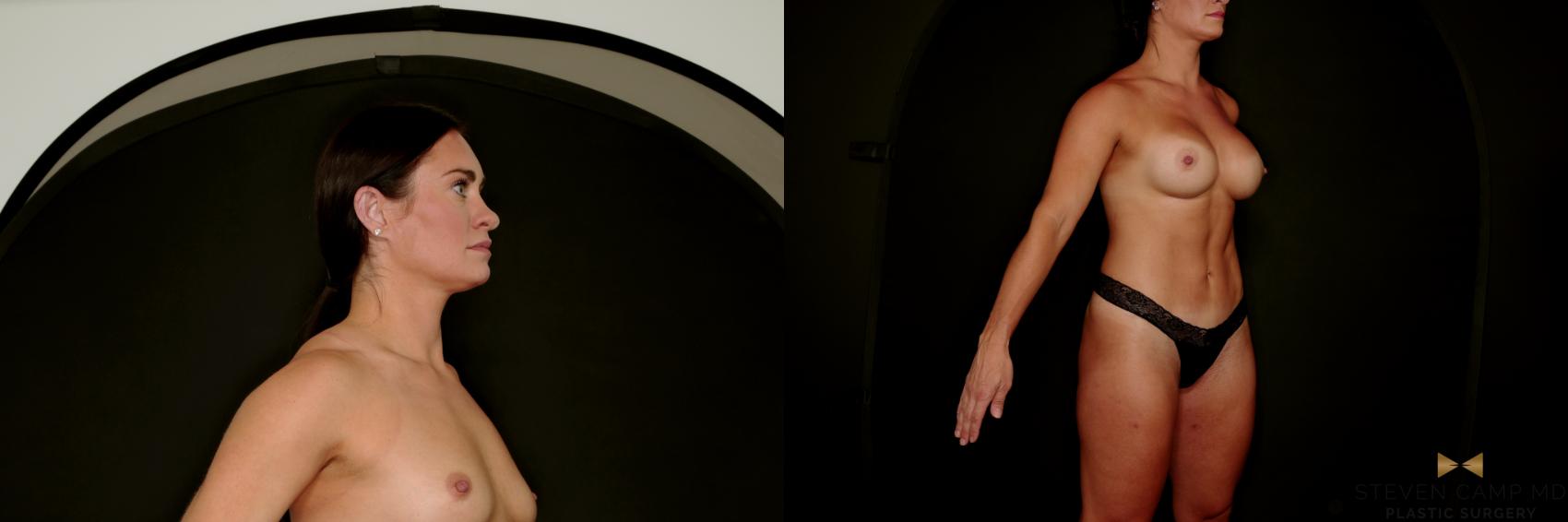 Before & After Tummy Tuck Case 746 Right Oblique View in Fort Worth & Arlington, Texas