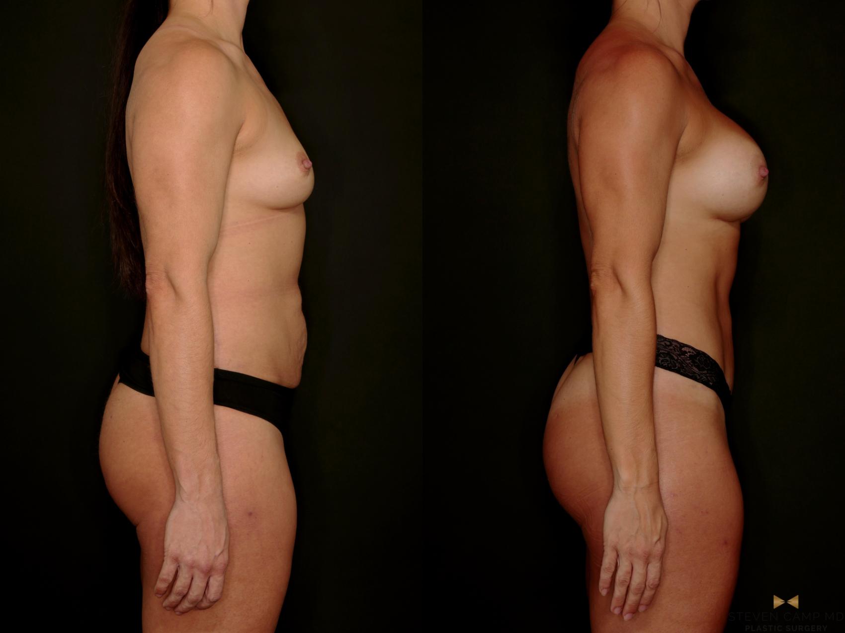 Before & After Tummy Tuck Case 746 Right Side View in Fort Worth & Arlington, Texas