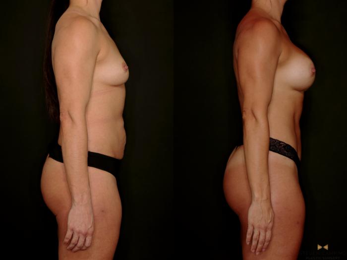 Before & After Tummy Tuck Case 746 Right Side View in Fort Worth & Arlington, Texas