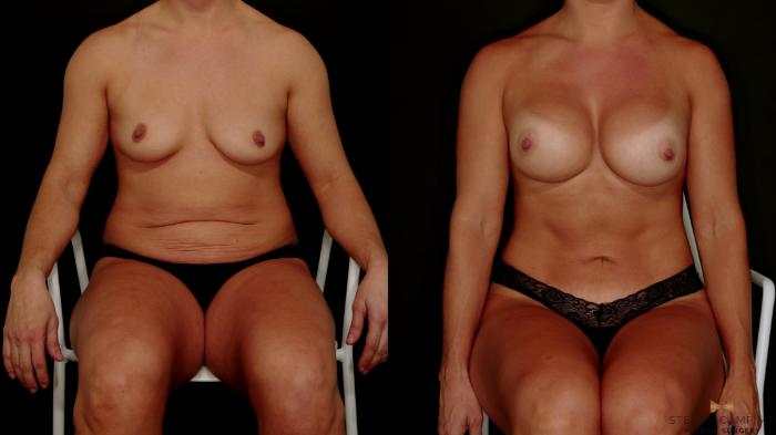 Before & After Tummy Tuck Case 746 Seated View in Fort Worth & Arlington, Texas