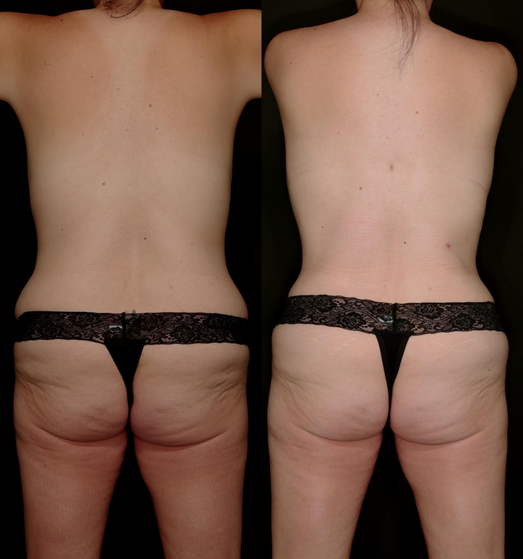 Before & After Mommy Makeover Case 757 Back View in Fort Worth & Arlington, Texas