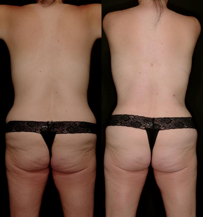 Before & After Mommy Makeover Case 757 Back View in Fort Worth & Arlington, Texas