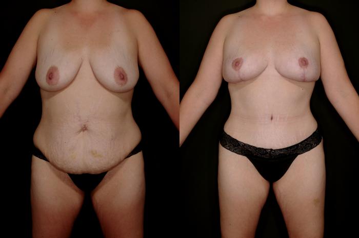 Before & After Mommy Makeover Case 757 Front View in Fort Worth & Arlington, Texas