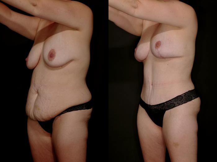 Before & After Mommy Makeover Case 757 Left Oblique View in Fort Worth & Arlington, Texas