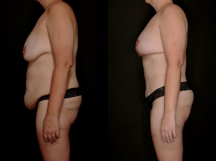 Before & After Mommy Makeover Case 757 Left Side View in Fort Worth & Arlington, Texas