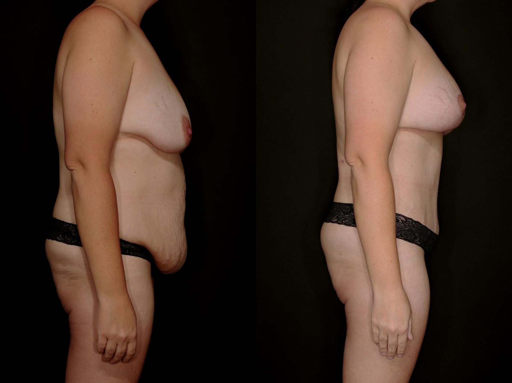 Before & After Mommy Makeover Case 757 Right Side View in Fort Worth & Arlington, Texas