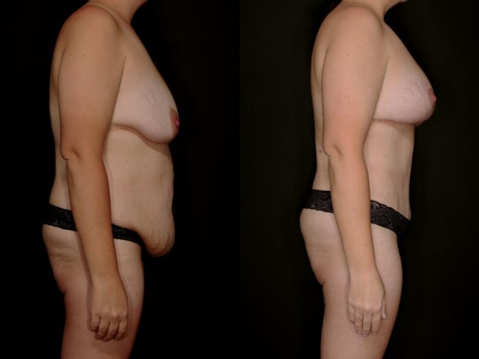 Before & After Mommy Makeover Case 757 Right Side View in Fort Worth & Arlington, Texas