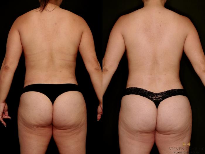 Before & After Mommy Makeover Case 768 Back View in Fort Worth & Arlington, Texas