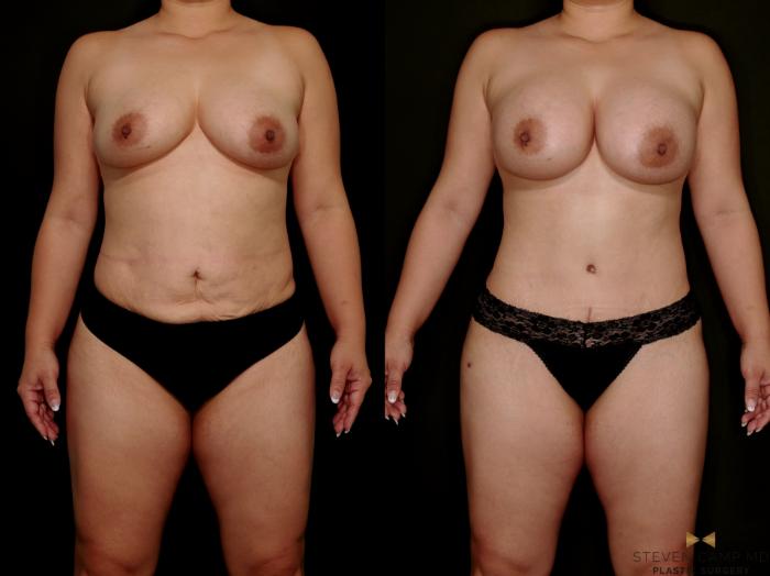 Before & After Mommy Makeover Case 768 Front View in Fort Worth & Arlington, Texas