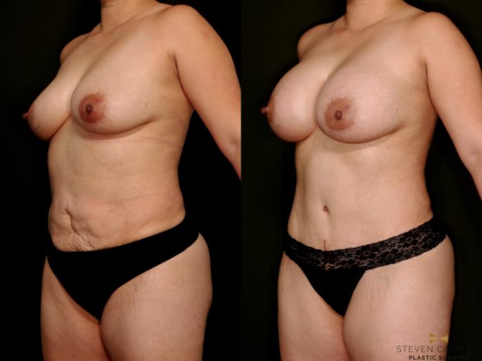 Before & After Mommy Makeover Case 768 Left Oblique View in Fort Worth & Arlington, Texas