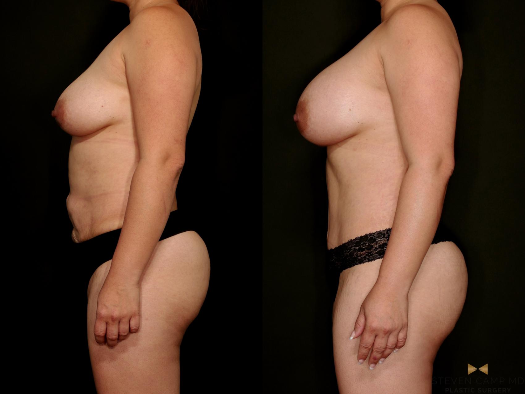 Before & After Mommy Makeover Case 768 Left Side View in Fort Worth & Arlington, Texas
