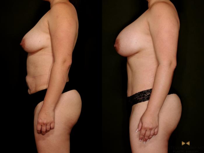 Before & After Mommy Makeover Case 768 Left Side View in Fort Worth & Arlington, Texas