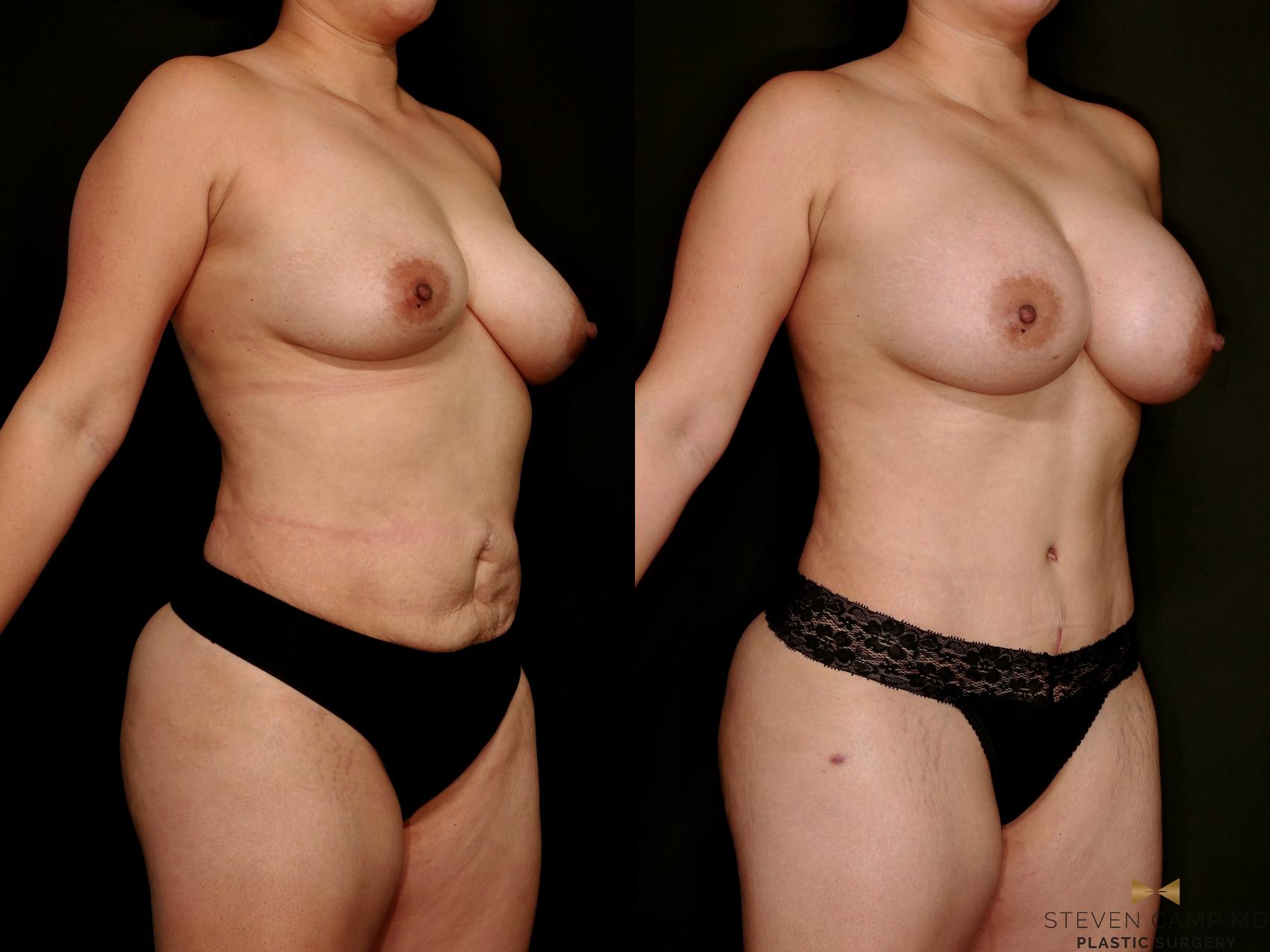 Before & After Mommy Makeover Case 768 Right Oblique View in Fort Worth & Arlington, Texas