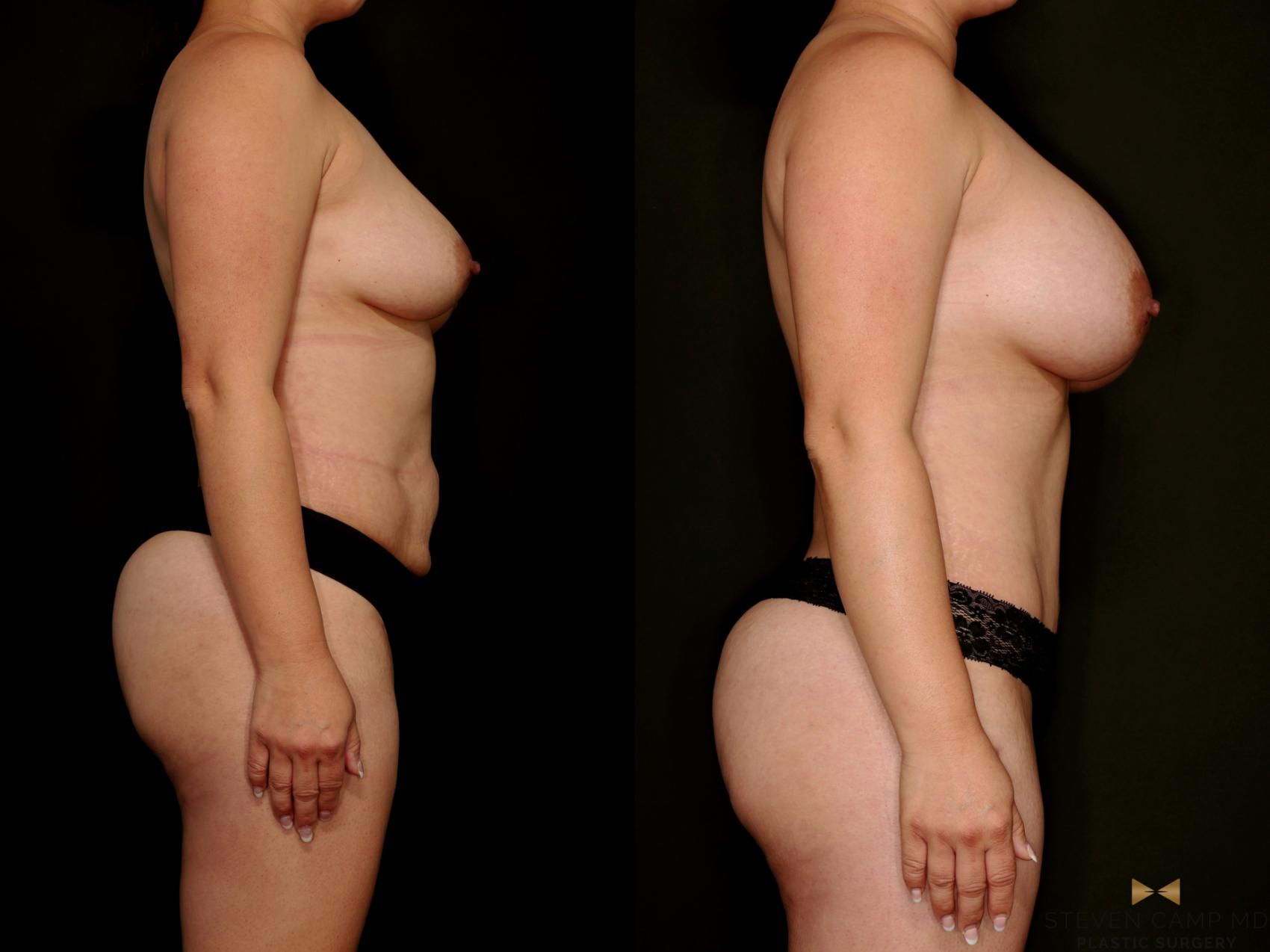 Before & After Mommy Makeover Case 768 Right Side View in Fort Worth & Arlington, Texas