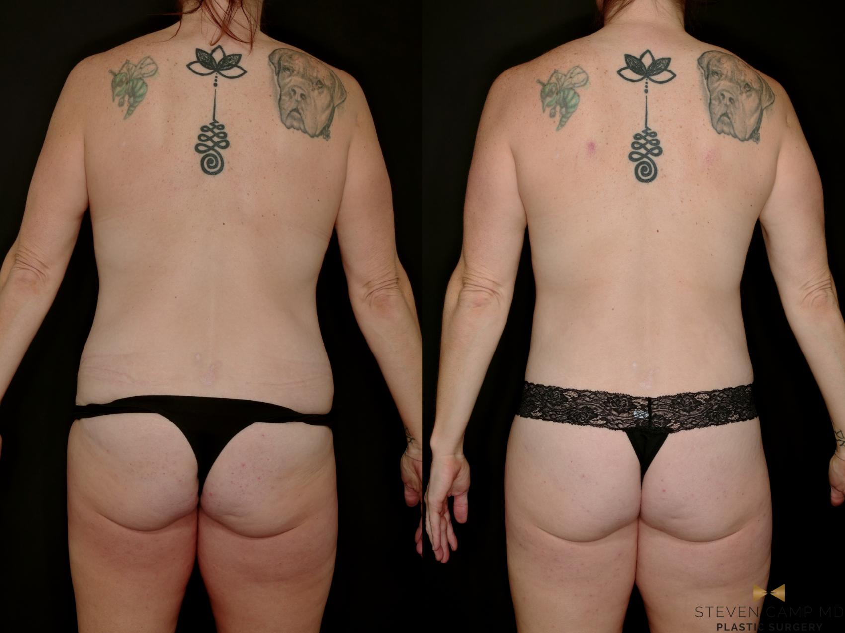 Before & After Mommy Makeover Case 769 Back View in Fort Worth & Arlington, Texas