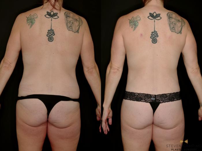 Before & After Mommy Makeover Case 769 Back View in Fort Worth & Arlington, Texas