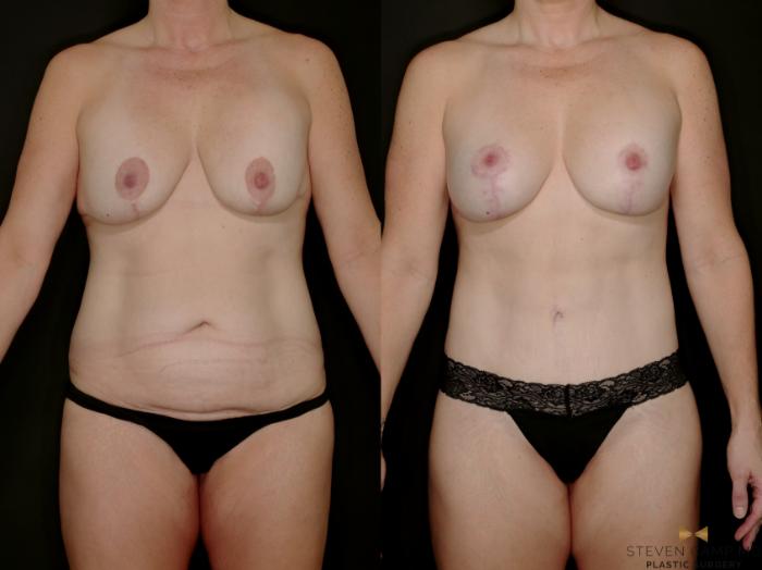 Before & After Mommy Makeover Case 769 Front View in Fort Worth & Arlington, Texas